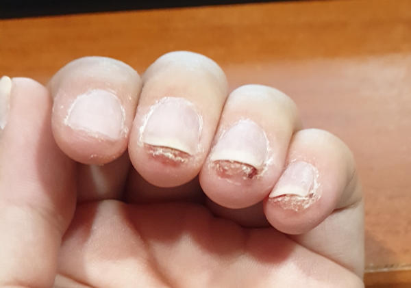 Uczulenie na hybrydę - skóra na opuszkach po obcięciu paznokci