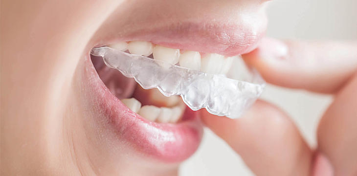 Nowe standardy w stomatologii - Invisalign i leczenie zębów pod narkozą.