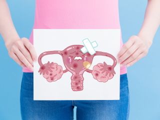 Czy endometriozę da się wyleczyć?