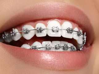 Kiedy trzeba zdecydować się na aparat ortodontyczny?