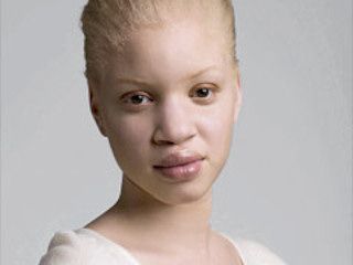Albinizm - biała klątwa...
